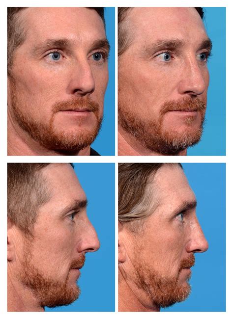 Rhinoplasty Before And After Photos