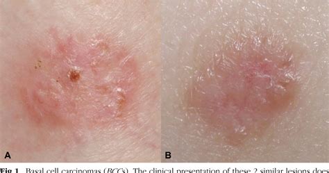 Figure 1 from Accuracy of dermoscopic criteria for discriminating ...