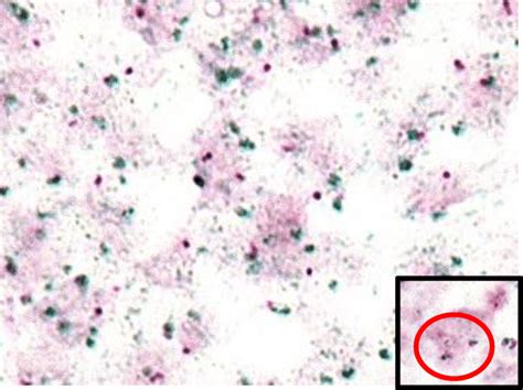 Bcl 2 Chromogenic In Situ Hybridization Cish Bcl 2 Cish Displayed