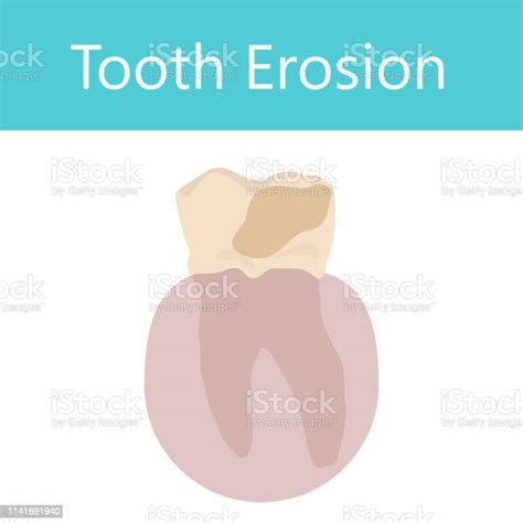 Lérosion Dentaire Illustration De Lanatomie Dentaire Vectorielle Fond