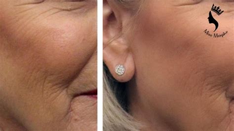 Micro Needling Before And After Miss Morpho