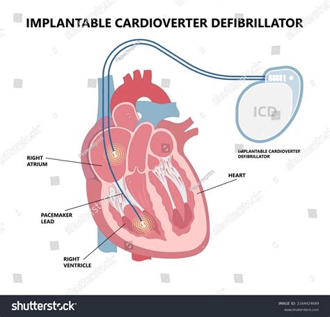 Pacemaker Icd Implantable Cardioverte Defibrillator Pulse Stock Vector ...