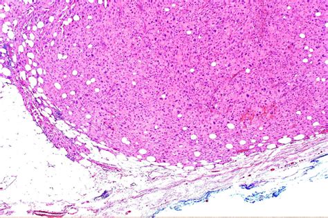 Uncommon Skin Cancer Pleomorphic Dermal Sarcoma Bmj Case Reports