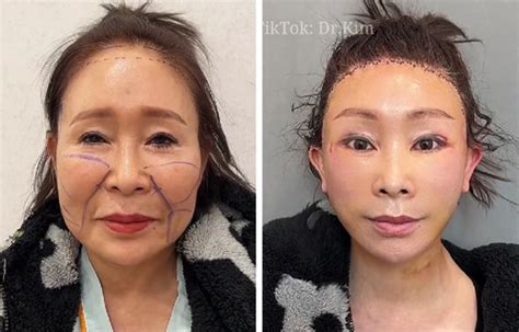 A Plastic Surgeon Goes Viral For His Transformation Videos Bright Side