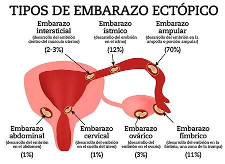 Embarazo Ectópico Mind Map