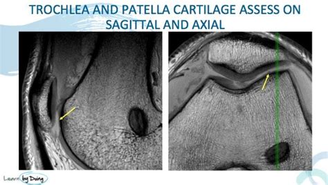 MRI Cartilage - Radedasia