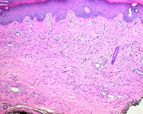 Granuloma Annulare Histology