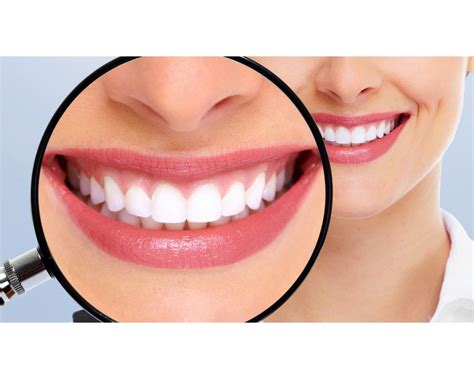 Existen tipos de blanqueamiento dental Cuáles son OdontoVida