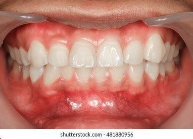 Asian Men Have Teeth Dirty Unclean Stock Photo 713027383 Shutterstock