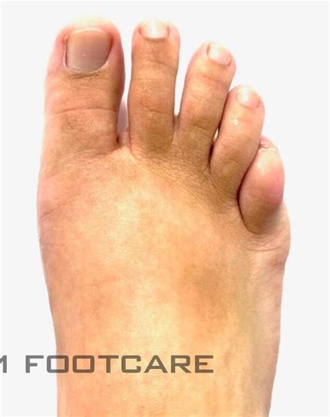 Bunion Surgery NYC Bunion Surgery Manhattan