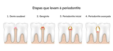 Periodontite Sintomas Causas Tratamento E Prevenção