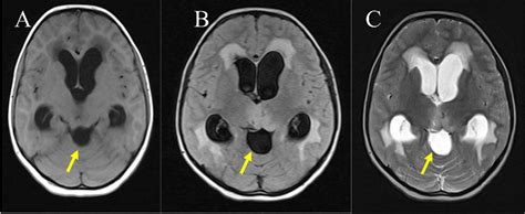 Figure 1 From Arachnoid Cyst In The Quadrigeminal Cistern A Case From