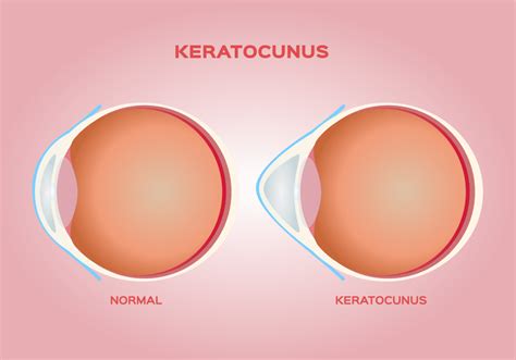 Eye Rubbing And Keratoconus Eye Etiquette Optical