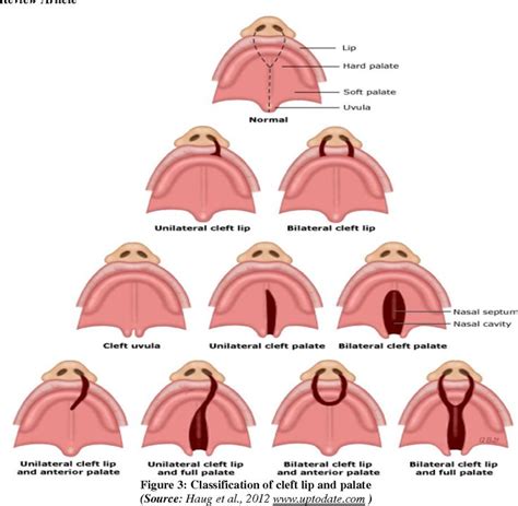 Cleft Lip And Palate Diagram