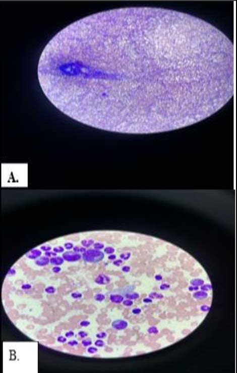 A Hypercellular Bone Marrow B X Magnification Myeloid