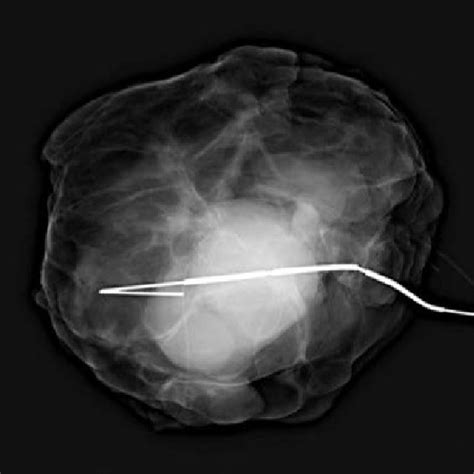 Lumpectomy Specimen X Ray Demonstrated The Presence Of Both The Mass