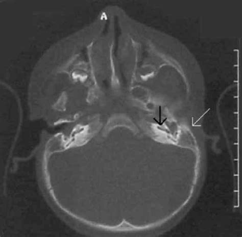 Left sided congenital aural atresia in the child. Note the aural... | Download Scientific Diagram