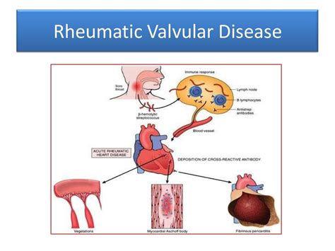 Rheumatic Heart Disease Symptoms Rheumatic Symptoms Diseases Club