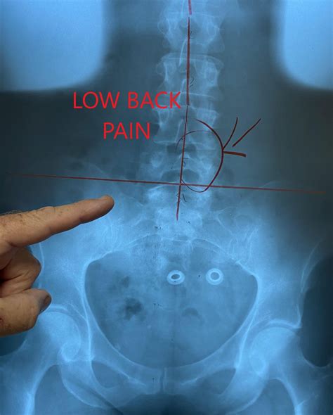 Low Back Pain from Deep Gluteal Syndrome - Swiesz Family Chiropractic