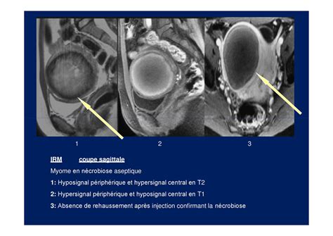 Myomes Uterins Present Par Dr Bicha Ppt T L Charger