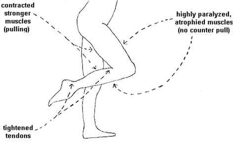 What Causes Muscle Contractures