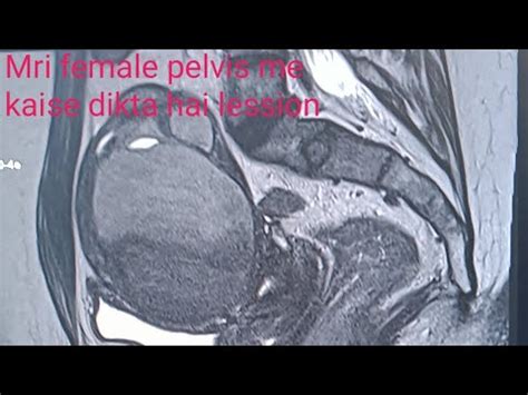 How To Do Mri Female Pelvis Live Demo Mri Pelvis Kaise Hota Hai Youtube