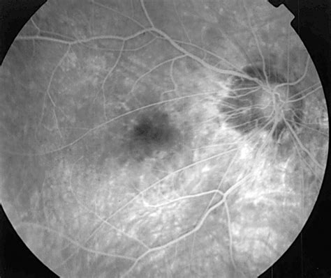 Fluorescein Angiography Late Phase Of The Right Eye Showing Download Scientific Diagram