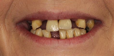 Examples of Before and After Dentures | First Class Dentures