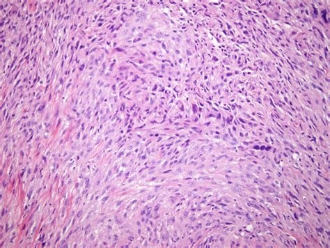 Pleomorphic Dermal Sarcoma Dermatopathology