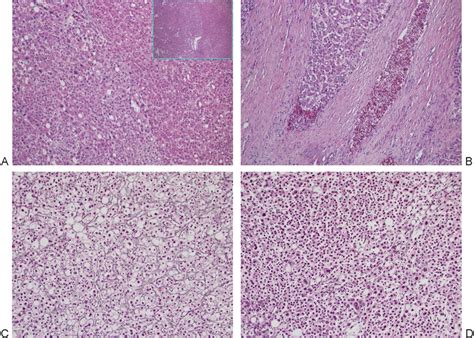 A Hepatocellular Carcinoma Hcc Area With Cellular Atypia On The Download Scientific Diagram