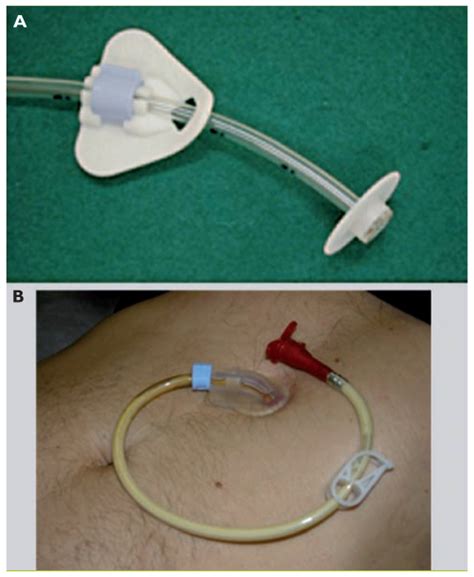 Nutrition entérale sonde nasogastrique ou gastrostomie percutanée