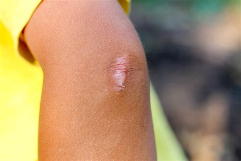 Tomate Nube Una efectiva que es bueno para las cicatrices en los niños