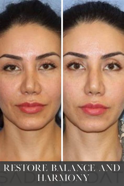 Non Surgical Rhinoplasty Before After Photos From Dr Kevin Sadati