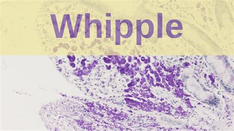 Whipple S Disease Pathology Mini Tutorial Youtube