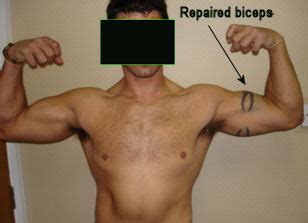 Bicep Tendon Rupture - ElbowDoc