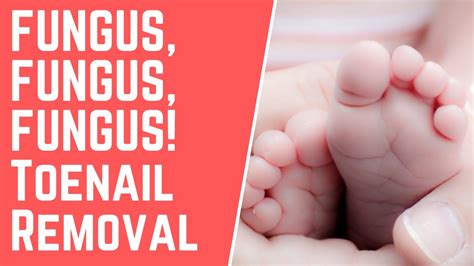 Fungus Fungus Fungus Toenail Removal Youtube