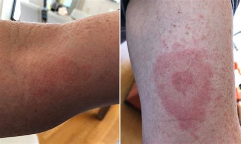 Lyme Disease Hotspot Is Declared After Mans Tick Bite Blows Up Into Huge Red Ring On His