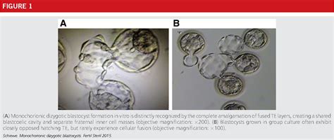 Figure 1 From Potential Risk Of Monochorionic Dizygotic Twin Blastocyst