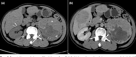 [pdf] Imaging Appearance Of Renal Epithelioid Angiomyolipoma A Rare