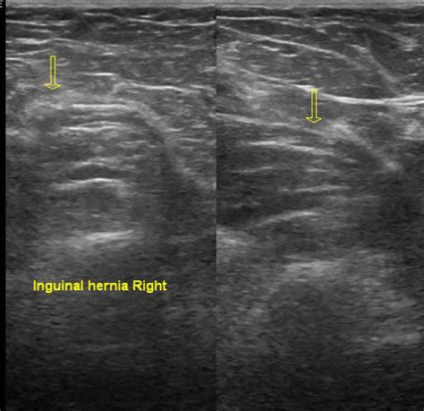 Radiopaedia Case Urinary Bladder Hernia Id 26649 Study 26796 NC Commons