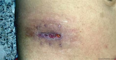 stab wounds scars wounds caused  sharp stab foot stock photo