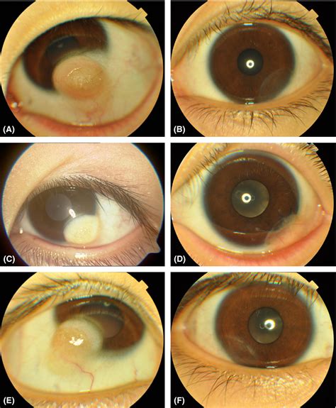 Surgical Management Of Limbal Dermoids Year Review Yao