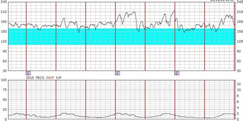 Fetal Heart Rate Fetal Heart Monitoring