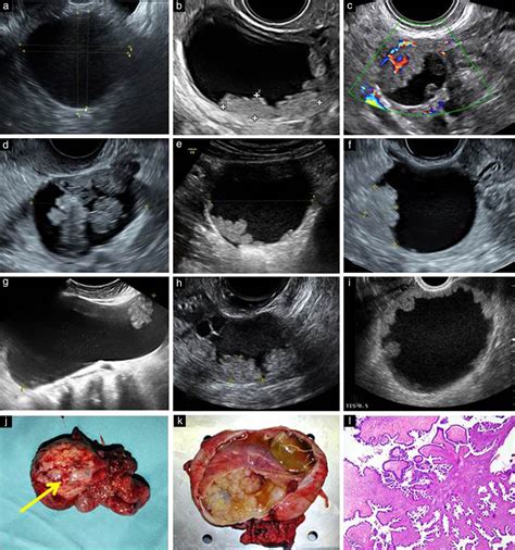 Ovarian Cancer Ultrasound