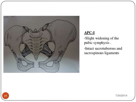 Pelvic Complex Fracture