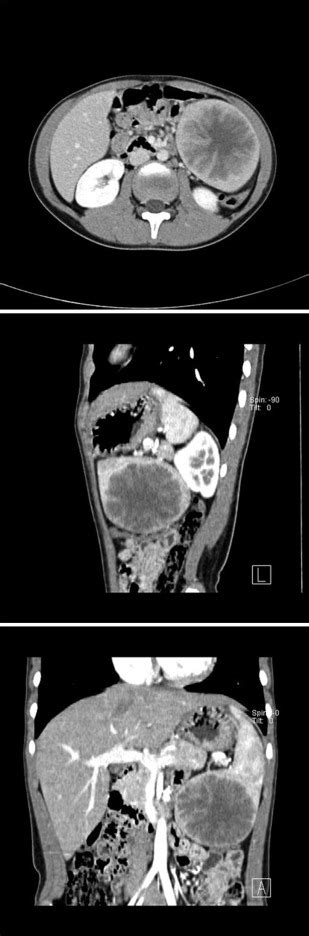 A Cavernous Splenic Lymphangioma In An 8 Year Old Boy Surgery