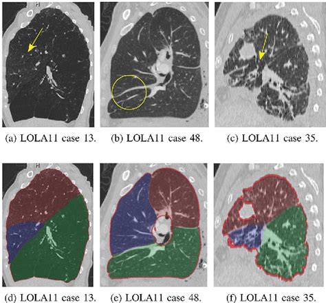 Figure 2 From Automatic Segmentation Of The Pulmonary Lobes From Chest