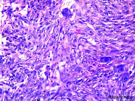 Patología Cc Fibroma No Osificante Non Ossifying Fibroma Fibrous Cortical Defect