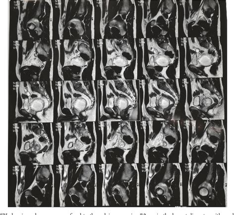 Figure 1 From Primary Mature Cystic Teratoma Compressing The Prostate