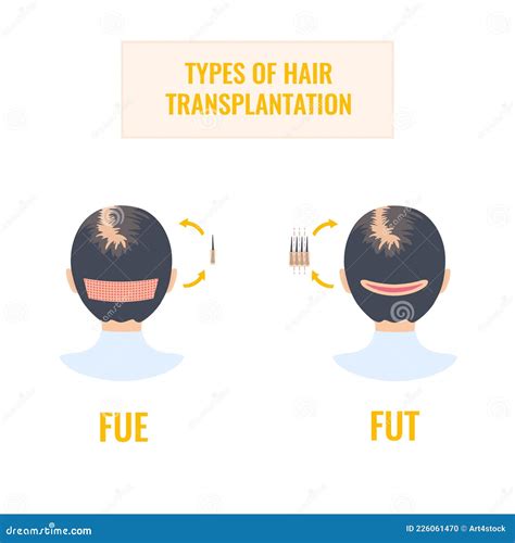 Female Hair Transplantation Infographics Of Fut And Fue Methods Stock